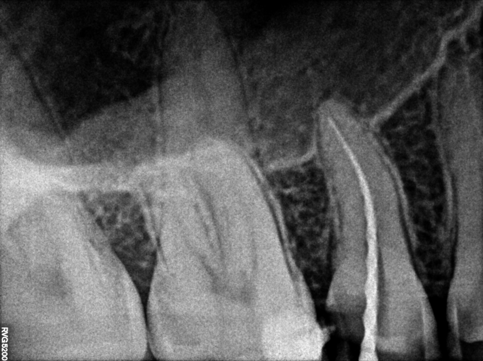 Dental X-ray